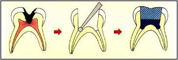 babyrootcanal